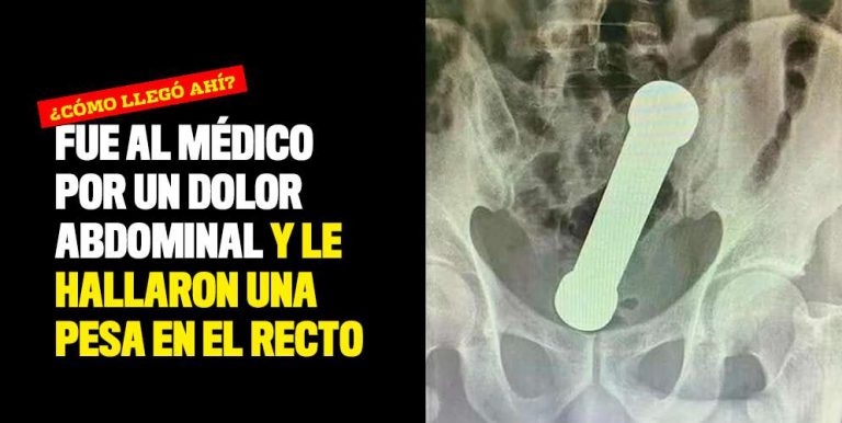 Fue al médico por un dolor abdominal y le hallaron una pesa en el recto