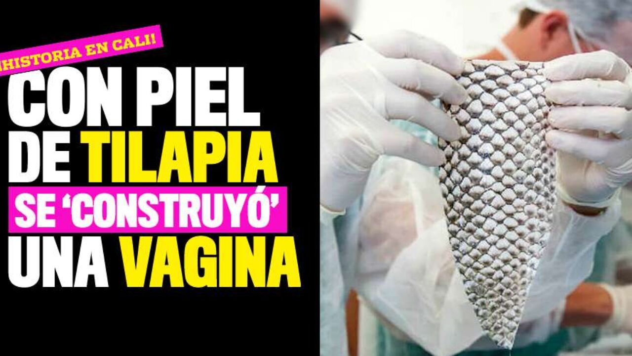 Reconstrucción de vagina con piel de tilapia en Cali