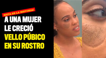 A una mujer le creció vello púbico en su rostro ¡Esta es la historia!