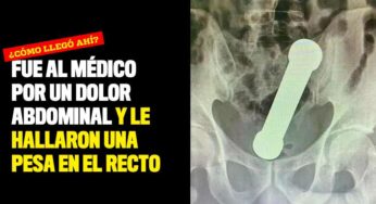 Fue al médico por un dolor abdominal y le hallaron una pesa en el recto