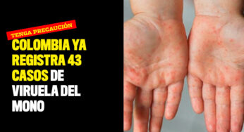 Colombia ya registra 43 casos de Viruela del Mono