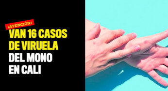 Van 16 casos de viruela del mono en Cali