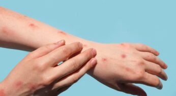 Le cambian el nombre a la viruela del mono por 'mpox' para evitar lenguaje racista